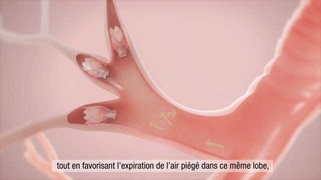 La valve endobronchique Zephyr® pour les personnes atteintes de BPCO et d'emphysème (Français) смотреть онлайн
