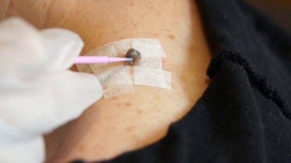 Skin tag removal - part 1 application