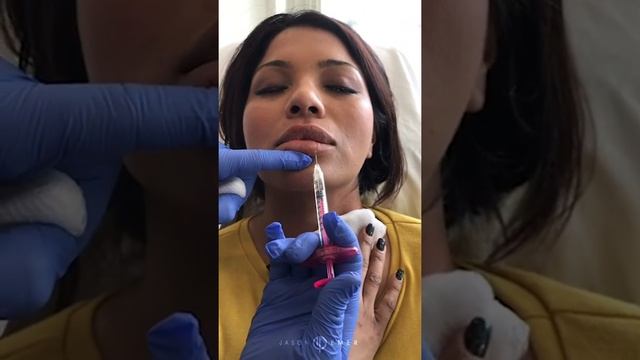 Dermal Fillers Belotero for Neck Lines TECH NECK | Volbella to Volumize Lips | DR JASON EMER смотреть онлайн