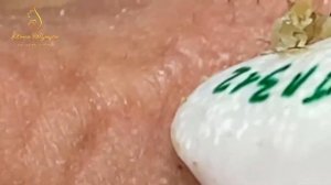 выдавливание прыщей | выдавливание чёрных точек