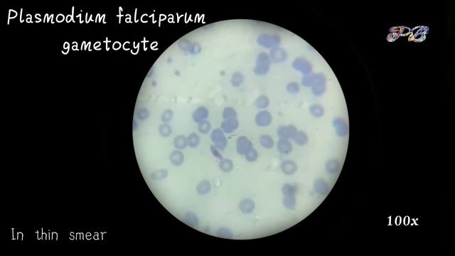 Malaria parasite plasmodium falciperum gametocyte in thick and thin blood smear in microscopic slid смотреть онлайн