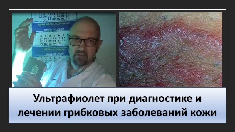 Ультрафиолет при диагностике и лечении грибковых заболеваний кожи смотреть онлайн