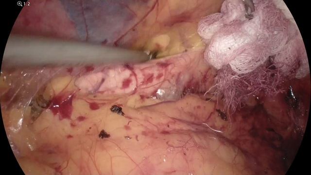 Laparoscopic sigmoid resection D2 смотреть онлайн
