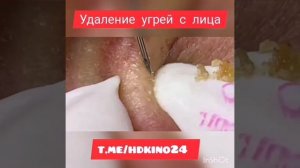 Удаление и выдавливание чёрных точек угрей прищей на лице новое#шортс #shorts #угри #угри на лице