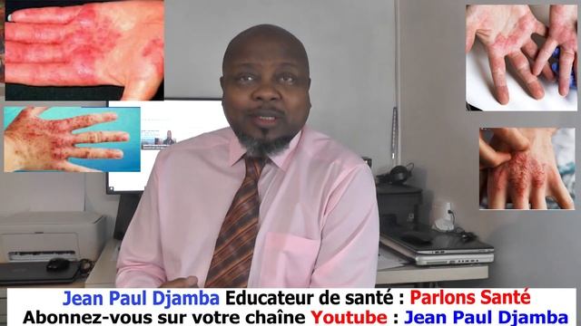 L'ECZÉMA DE CONTACT(ou Dermatite de Contact): Causes, Traitements et Prévention. смотреть онлайн