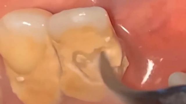 Massive Giant Teeth Tartar Removal  Get Rid Of Hard Plaque On Teeth #22