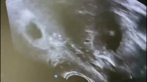 Вакуум аспирация по УЗ контролем