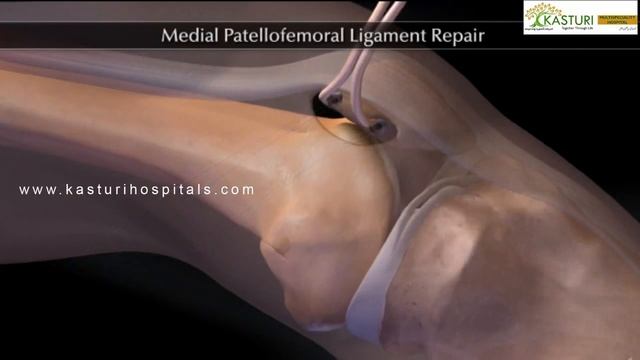 Knee Cap Surgery Hyderabad | Patella Dislocation Treatment | Patellofemoral Ligament Repair