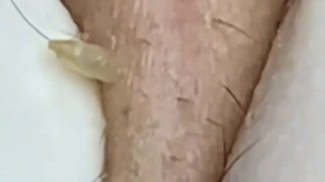 Огромные прыщи. Удаление и выдавливание черных точек. Чистим лицо.