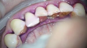 Чистка зубного камня | teeth tartar and plaque cleaning #dental #dentist #dentistry #teeth #