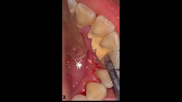 удаления зубного камня смотреть на ютуб tartar removal watch on youtube 10 смотреть онлайн