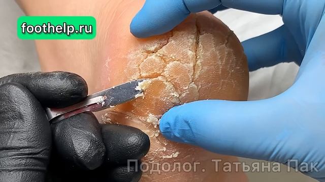 Пятки до состояния потрескавшейся земли. Колонии грибов в условиях влажной среды #подологтатьянапак смотреть онлайн