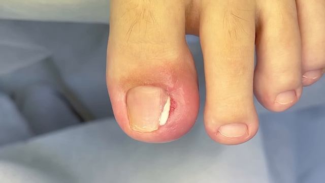 Удалить вросший осколок ногтя. Почему ноготь похож на форму #подологтатьянапак смотреть онлайн