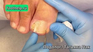 Острая фаза при вросшем ногте за 14 дней