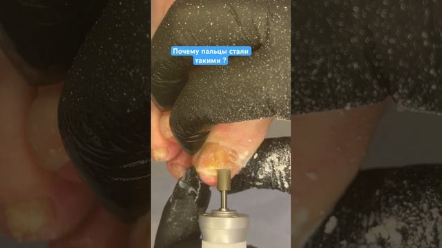 Полное видео смотрите на моем канале #подологтатьянапак смотреть онлайн