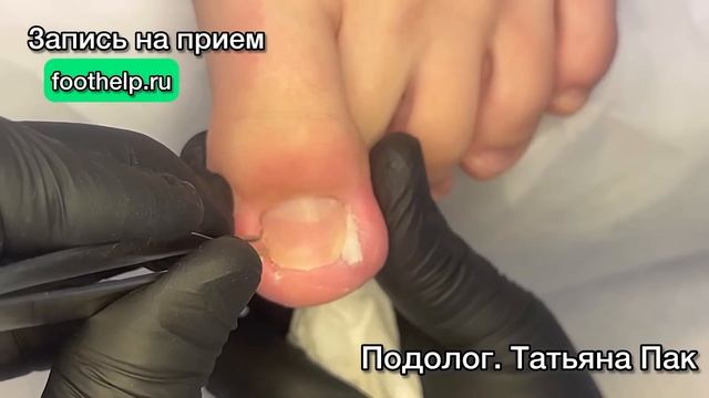 «Рогатка» в мясе бокового валика у ребенка 11 лет смотреть онлайн