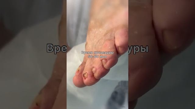 Первый этап в лечении грибка на ногтях - подологическая чистка #грибокногтейлечение #подологмосква смотреть онлайн