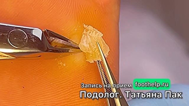 Корень у мозоли растет до кости. Миф или реальность? Байки пациента смотреть онлайн