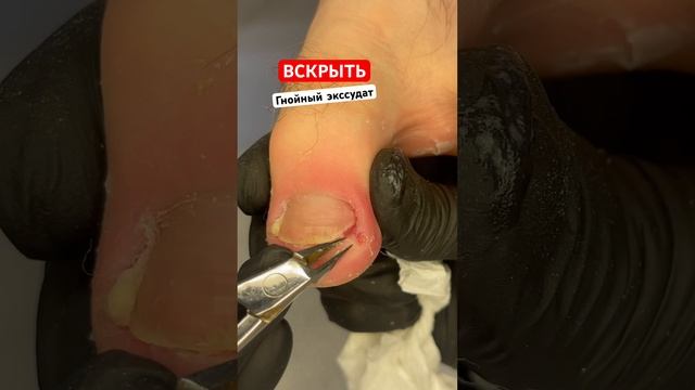 Вскрыть гнойный экссудат #гнойный #вросшиеногти смотреть онлайн