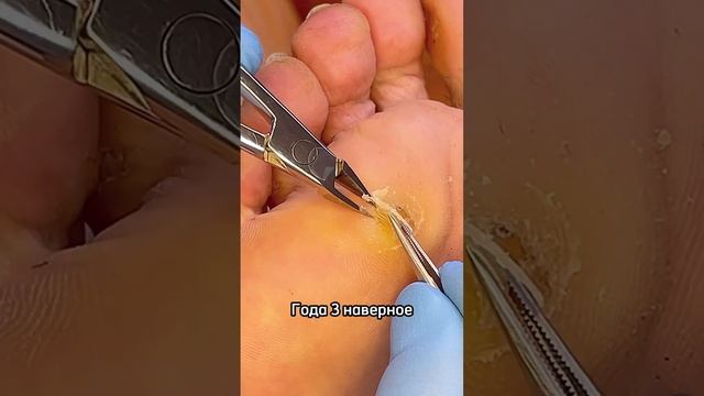 Мозоль глубиной 1 см. Запись на прием ➡️ foothelp.ru смотреть онлайн