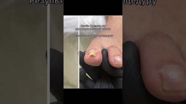 Волшебство за один прием. Как сделать узкий ноготь снова широким #скобыдляногтей #вросшийноготь смотреть онлайн