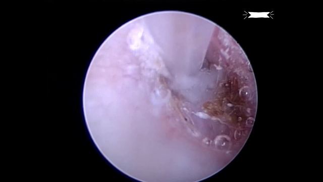Первичный секреторный средний отит у собаки - удаление слизи. Canine PSOM, satisfying mucus remova смотреть онлайн
