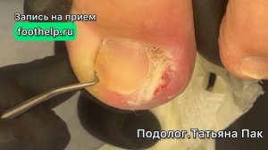 Каждый испытал ЭТО на себе. Вросший ноготь