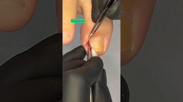 Дикое мясо от вросшего ногтя #подологмосква #вросшиеногти смотреть онлайн