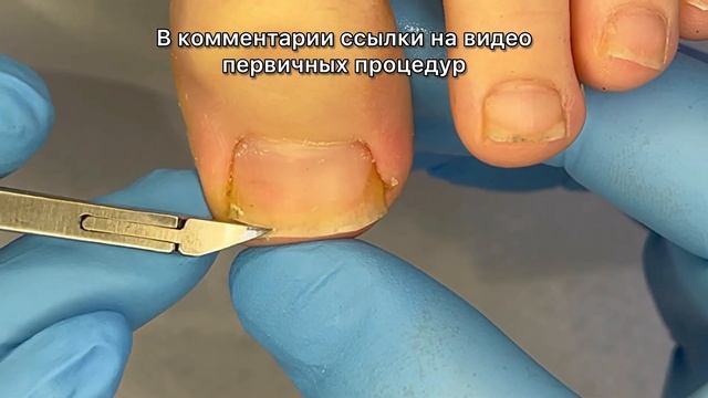 Лечение вросшего ногтя. Динамика за 6 месяцев. Смотрите предыдущее видео смотреть онлайн
