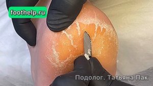 Как раскрыть каждую трещину на пятке #подологтатьянапак