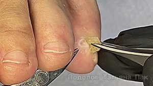 Болезненные мозоли на мизинцах #подологтатьянапак