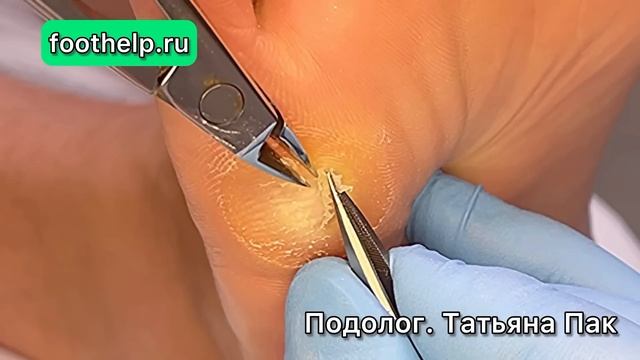 Мозоль размером XXL смотреть онлайн