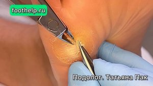 Мозоль размером XXL