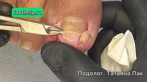 И снова растет вросшим. Почему так бывает