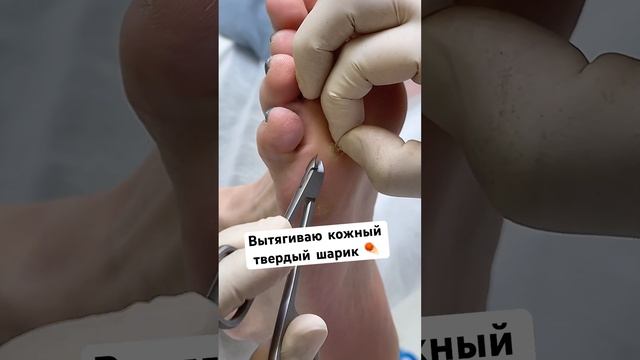 Твердая, круглая и очень болит ☄️ #мозоли #твердаямозоль #сухаямозоль #подологмосква смотреть онлайн