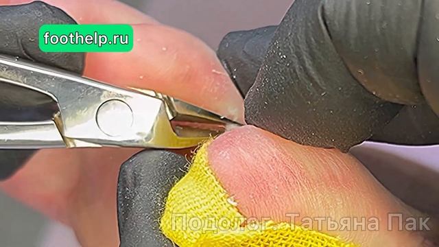 Фиброзная ткань под сухой мозолью, которая болит, колет, печет и пульсирует #подологтатьянапак смотреть онлайн