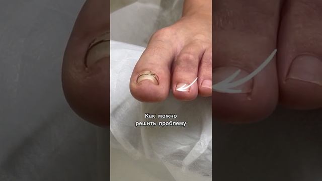 Куда врастает ноготь #подолог #вросшийноготь смотреть онлайн