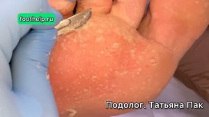 Влажные стопы | причина заболевания | услуги подолога