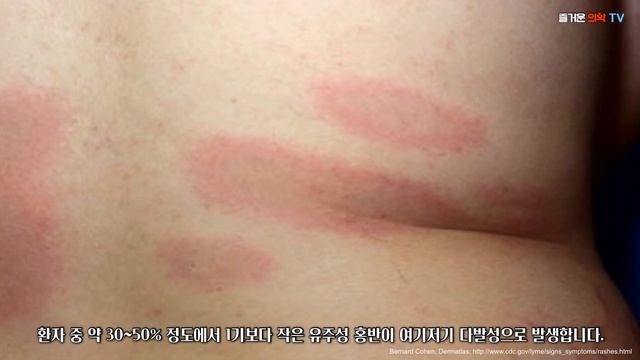 라임병에 걸리면 어떻게 될까? Lyme Disease [feat. 라임라이프]