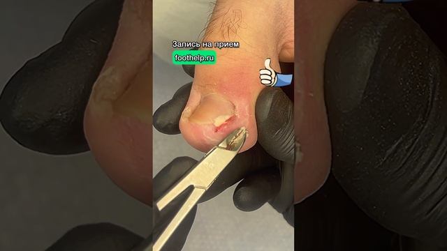 Запись на прием ➡️ foothelp.ru Еще больше видео на моем канале @podologmoscow #вросшиеногти смотреть онлайн