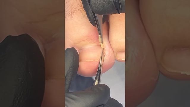 #вросшиеногти смотреть онлайн