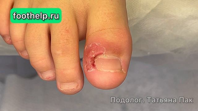 Почему подростки обращаются к подологу. Решить проблему вросшего ногтя быстро и не больно смотреть онлайн