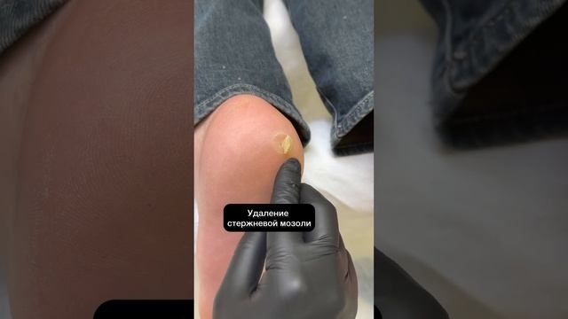 Удалить корневую мозоль у @podologmoscow #мозоли смотреть онлайн