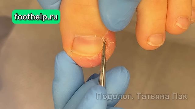 Плакал, но доверял. История вросшего ногтя у ребенка 10 лет #подология смотреть онлайн