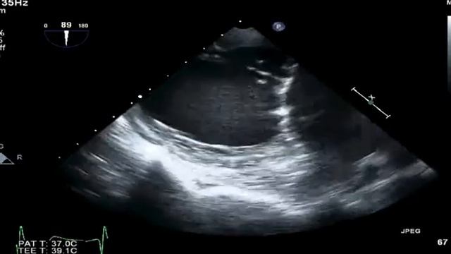 TEE transgastric 90 degrees long axis mitral valve Example 1 смотреть онлайн