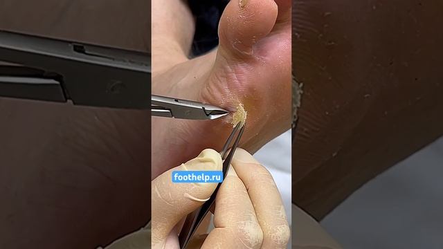 Твердая #мозоль под мизинцем #удалениемозоли #стержневаямозоль #подологтатьянапак смотреть онлайн