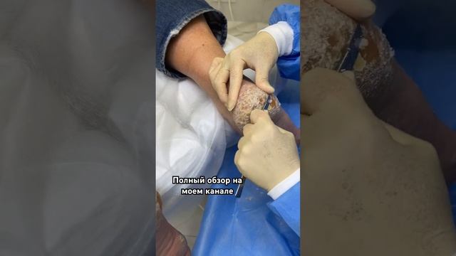 Полную версию shots смотрите на моем канале ПОДОЛОГИЯ ногтей и стоп #пятки #гиперкератоз смотреть онлайн