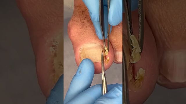 Как удалить вросший ноготь БЕСПЛАТНО #подологмосква смотреть онлайн