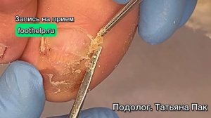 Восстановить чувствительность пальца. Освобождение ногтя от кожных залежей и обширной гематомы.