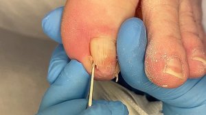 Трубчатый ноготь с обширной гематомой #подологтатьянапак